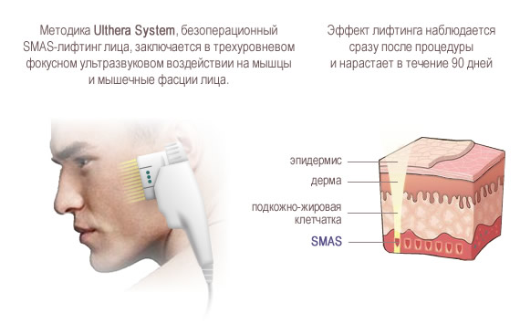 Ulthera System